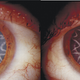 Illustration for article titled A 14,000-volt electrical shock gave this man star-shaped cataracts